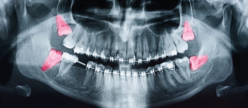 Wisdom Teeth Leeds