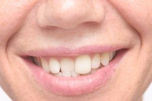 Veneers for Crooked Teeth Leeds