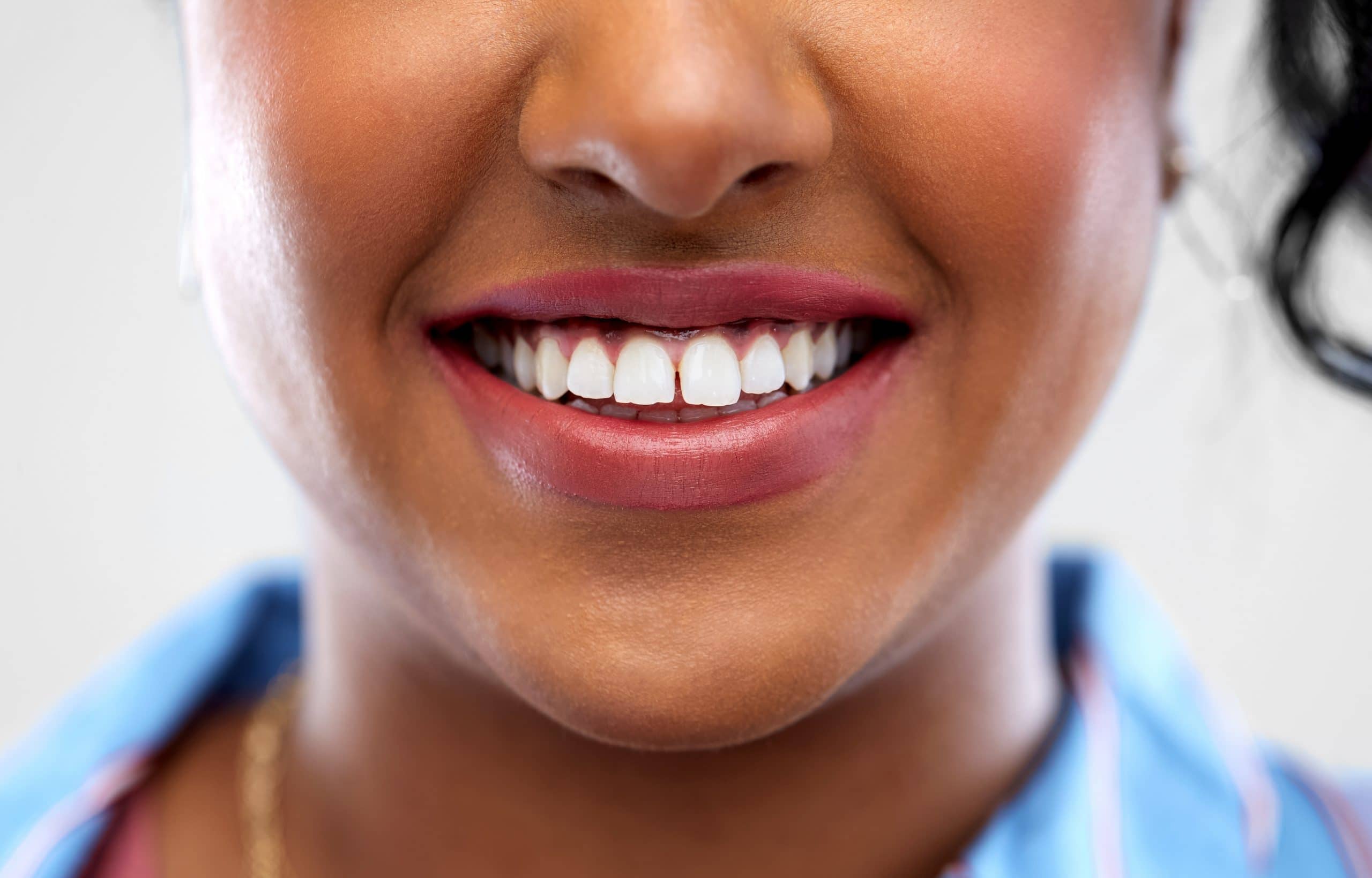 Veneers and braces for Gappy Teeth Leeds