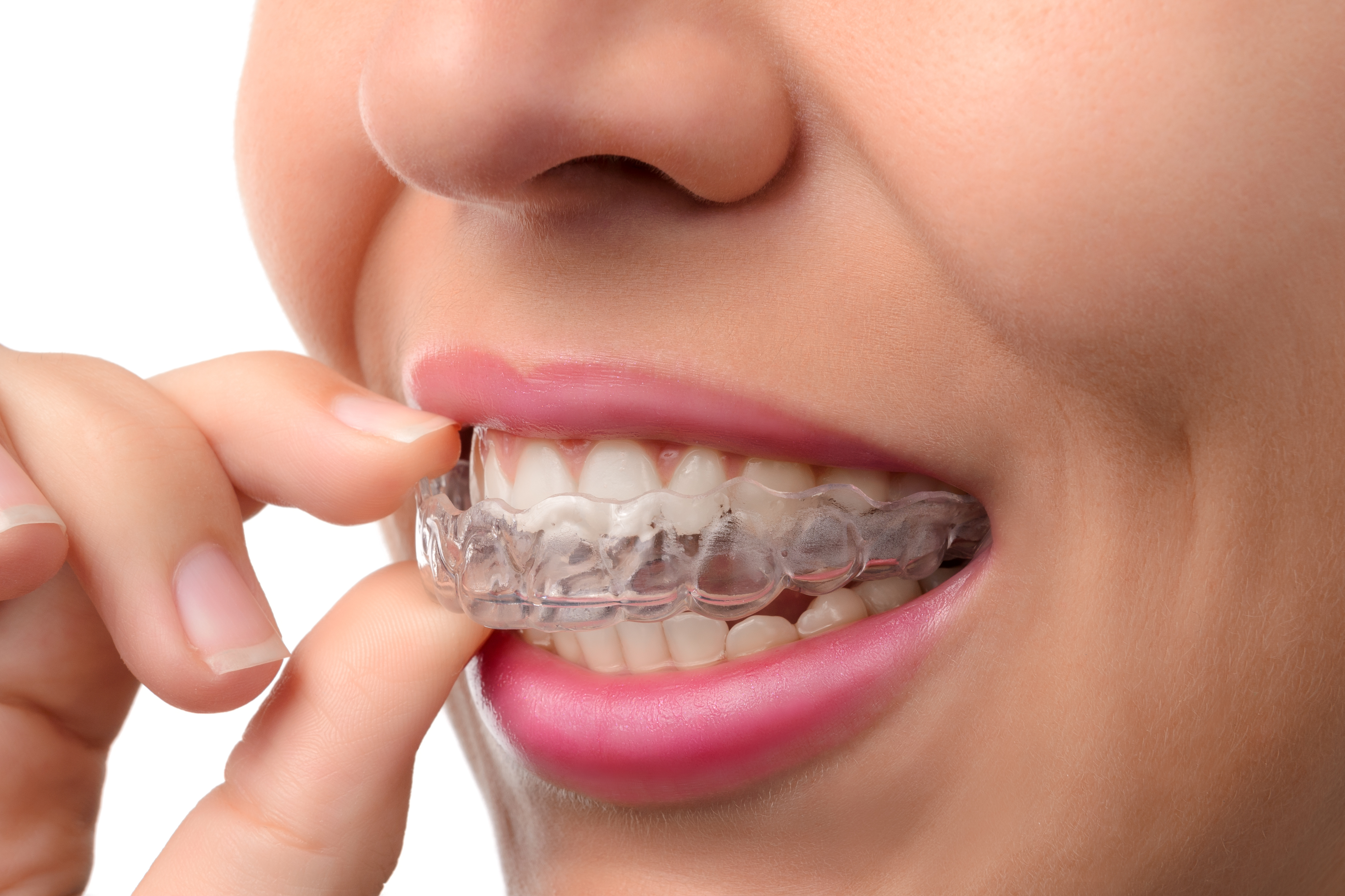 Invisalign Leeds