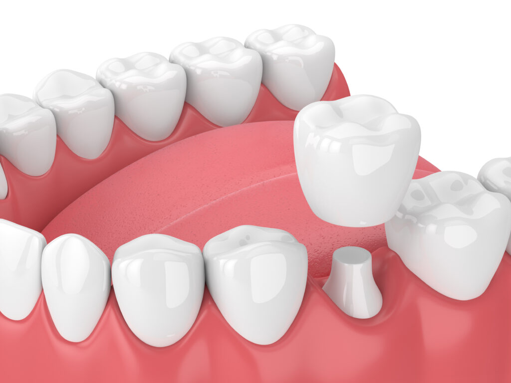 Dental Crowns Leeds