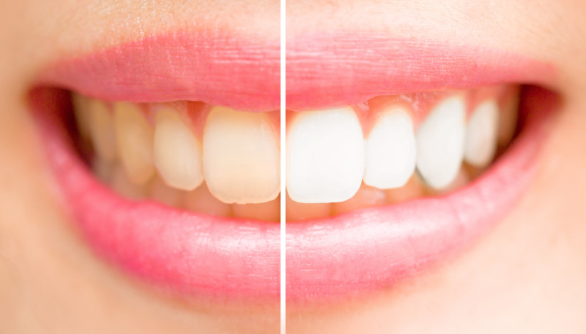 Teeth Whitening Bradford