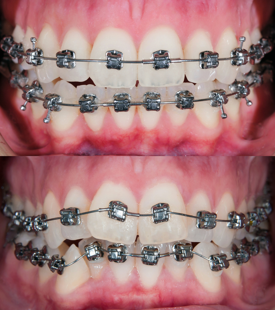 Braces Leeds