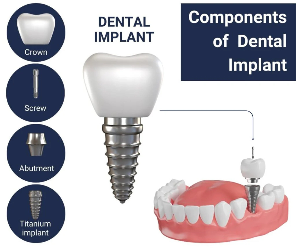 dental implant